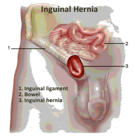 Descripción: http://healthebd24.com/wp-content/uploads/2013/12/Inguinal-Hernia.png