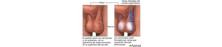 prostatitis és varicoceliers)