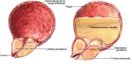 Prostatitis hernia Prostatitis cső húgyhólyagból